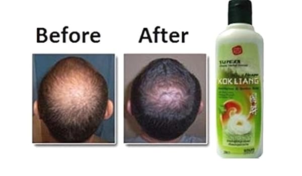 Amazon Com 2x200ml Kokliang Kok Liang Herbal Shampoo Anti