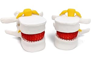 EVOTECH SCIENTIFIC Human Herniated Disc Model, Anatomical Herniated Lumbar Vertebrae Disc Prolapse Model for Medical Teaching Learning Education Display Tool