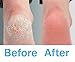PURSONIC Black Battery Operated Callus Remover, Foot Spa and Foot Smoother CR360 W/ 2 Cartridge Rollers