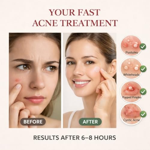 Primebly™ Acne Patches 360 Count | Pimple Patch & Hydrocolloid Patch لصقات حب الشباب | Invisible Waterproof for Face & Body | Fast-Acting Blemish & Acne Spot Treatment – Vegan & Cruelty-Free