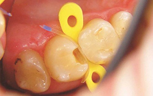 50 Dental Transparent Countured Matrices Matrix + 40 Elastic Wedges