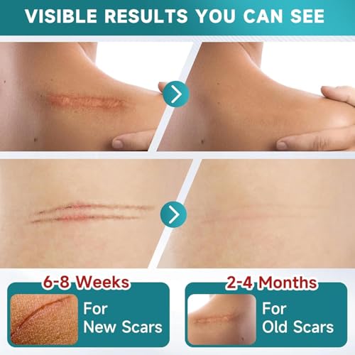 Silicone Scar Dressing 4 cm x 300 cm, Reusable Self Adhesive Silicone Band, Cuttable, Thin and Flexible, Comfortable for Different Body Areas