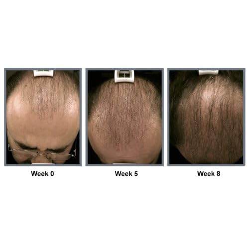 60 Off Thinning Hair Treatment For Men And Women