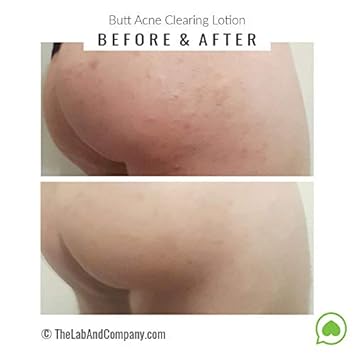 booty acne removal