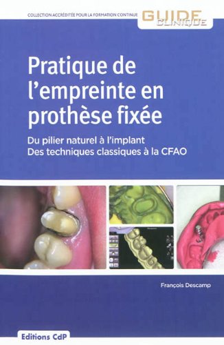 Pratique de l'empreinte en prothèse fixée
