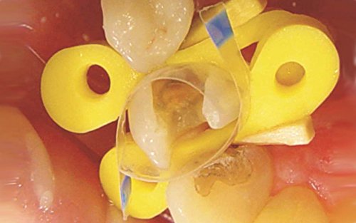 50 Dental Transparent Countured Matrices Matrix + 40 Elastic Wedges