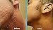 Exfoliating Brush to Treat and Prevent Razor Bumps and Ingrown Hairs - Eliminate Shaving Irritation for Face, Armpit, Legs, Neck, Bikini Line - Silky Smooth Skin Solution