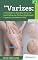 Livro Varizes: Tratamento e Receitas Naturais com Ênfase em Plantas Medicinais, Capsulas, Extratos e Chás - Volume 104