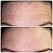 The Kami Pad Anti-Wrinkle Forehead Pad - Beauty Mask for Lifting & Hydrating Dry Skin. Antiwrinkle & Antiaging Repair & Prevention for Head Area. Safe Botox Alternative (1 Pack)