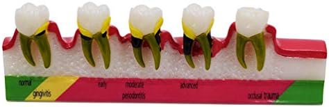 GEEFSU-Tooth Classification Demonstration Model Show Oral Dental Structure - for The Teaching Demonstration of Periodontology