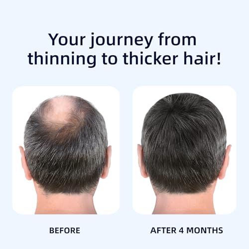 Hair Loss Serum 2 x 50 ml, Hair Growth Serum with Biotin, Lightweight Hair Densifier for Men and Women, Strengthening Hair Serum for Fine, Weak and Damaged Hair, Blue