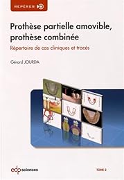 Prothèse partielle amovible, prothèse combinée