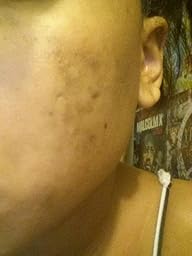 Amazon.com : BEST Scar Removal Cream Treatment: Advanced New & Old ...