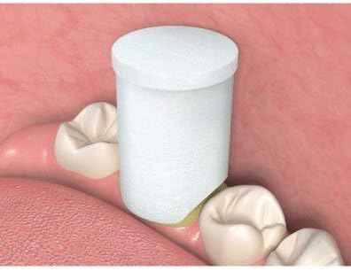 Premier Dental 9048260 Premier Retraction Caps Asstd 60/Pk