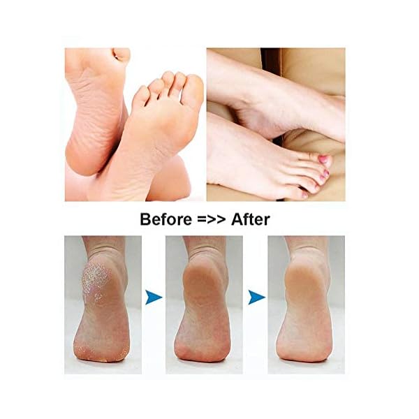 BOMPOW-Electronic-Foot-File-Hard-Skin-Remover-Pedicure-Tool-with-2-Roller-and-Rechargeable-Callus-Foot-Care-Tool-for-Dry-Dead-and-Cracked-Feet-Blue BOMPOW Electric Foot File, Hard Skin Remover for Feet, Pedicure Tool with 2 Roller and Rechargeable Callus Foot Care…