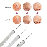 Hatop 3pcs Curved Blackhead Comedone Clip Needle Tweezers Pimple Extractor Remover