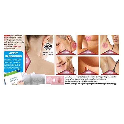 Biodermal Skin Tag Patches AS SEEN IN PRESS (1 Pack)