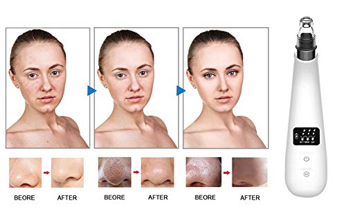 Blackhead Remover Vacuum Portable Blackhead Suction Tool with LED Display Facial Pore Cleanser Electric Acne Comedone Extractor Kit Women Christmas Gift (White)