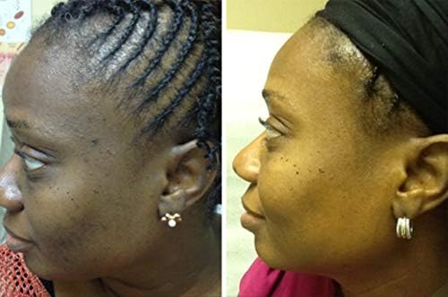 hydroquinone bleaching cream