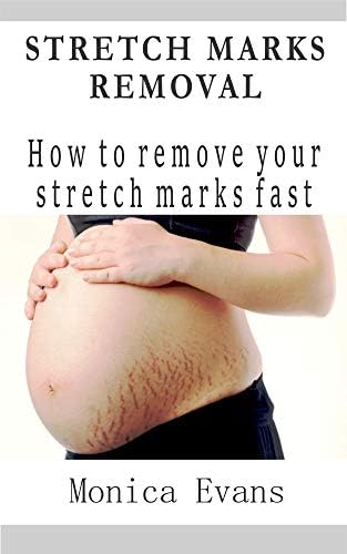 STRETCH MARKS REMOVAL: How to remove your stretch marks fast