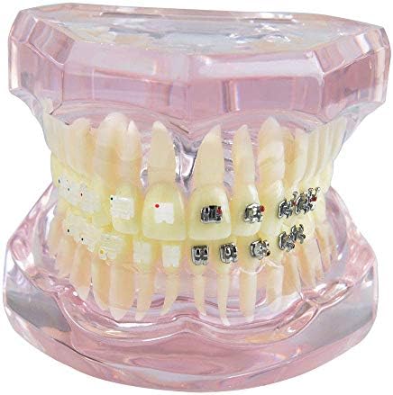歯科用金属とセラミックブレースの歯モデル 歯科用成人矯正モデル歯科用