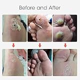 MQUPIN Corn Remover Pads 24 Pcs Foot Corn Plaster with Hole view 6