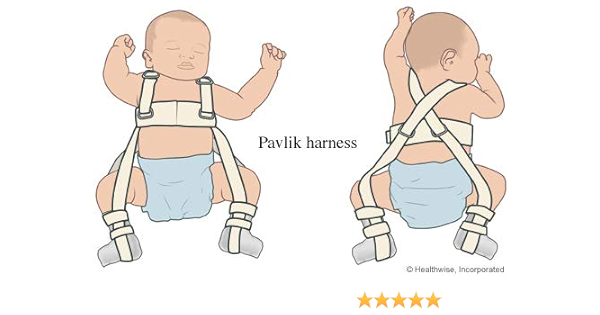  Pavlik Harness For Treatment Of Hip Dysplasia In Infants Babies Small 31 34 Cm Health Household