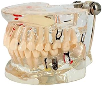 Adult dental pathology Dental implant model Dental lesion model Dental model for dental practice