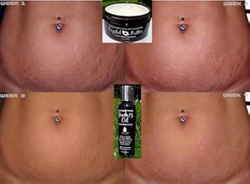 exfoliate stretch marks