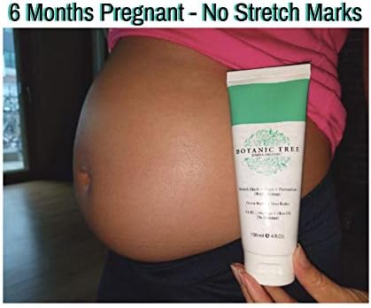 stretch marks cream for girl