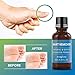 Natural Wart Remover, Maximum Strength, Painlessly Removes Plantar, Common, Genital Warts Infections, Advanced Liquid Gel Formula, Proven Results by Evaglossthumb 1