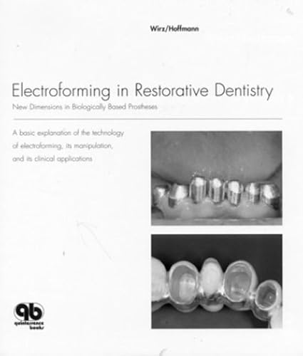 Download Electroforming in Restorative Dentistry: New Dimensions in Biologically Based Prosthses PDF