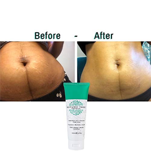 belly stretch marks removal cream