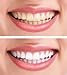 Triple Strength Laser Whitening Dental Creme and Teeth Bleaching Paste For Professional Use 50ml
