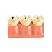 Easyinsmile 4 Times New Dental teeth model Patient Education Model Caries Disassembling tooth model
