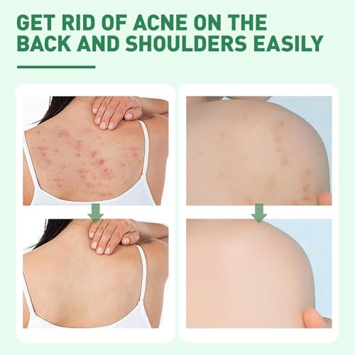 LBOYLOVE® Back Acne Treatment Spray – 2% Salicylic Acid & Hypochlorous Acid Spray for Body Acne, 120ml – Deep Cleansing, Fades Scars, Soothing Repair for Back, Chest & Shoulders