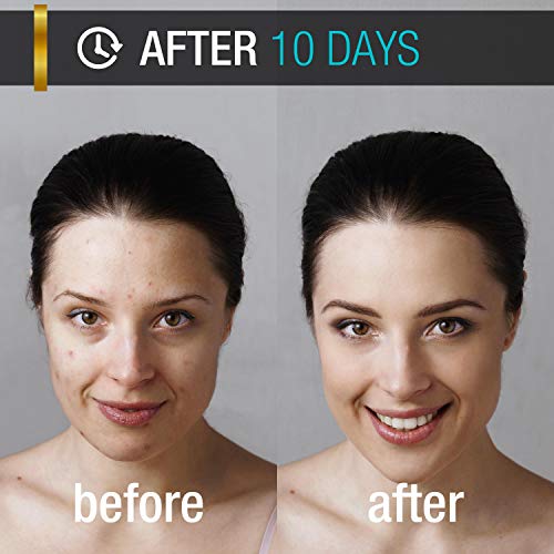 Vegan Acne Treatment for Face & Body Glow Back Acne Spot Treatment