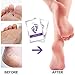VASSOUL Foot Peel Mask, Feet Callus Remover & Dead Skin Remover, Moisturizing and Whitening Feet, Baby Your Feet Naturally
