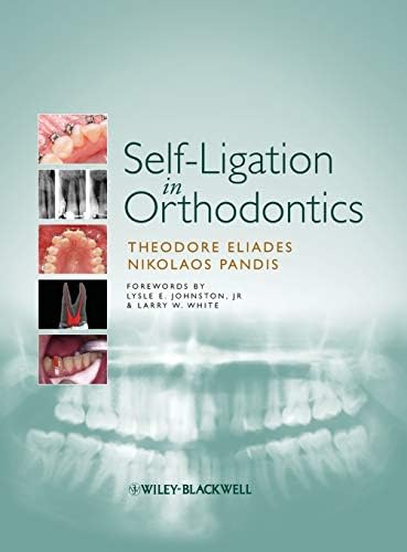 Self-Ligation in Orthodontics: An Evidence-based Approach to Biomechanics and Treatment