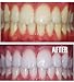 Professional Dental Strength 16% Teeth Whitening Gel. Includes 4 XL 10cc Syringes of Whitening Gel! FDA Approved! Made in USA!