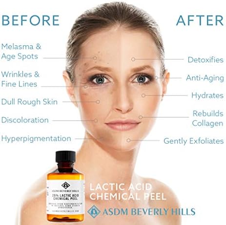 lactic acid peel