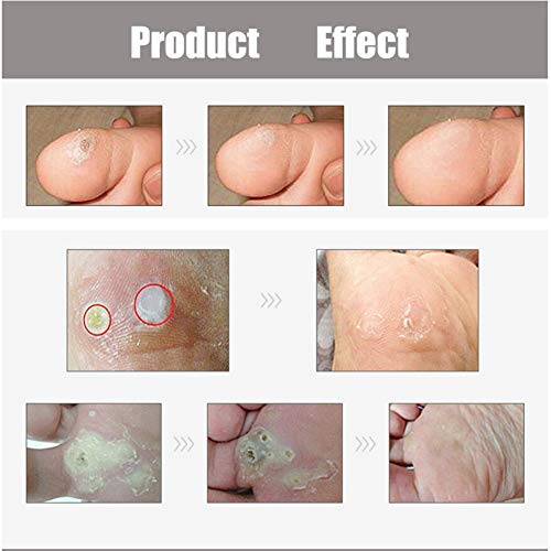 Corn Remover, Callus and Corn Remover Liquid, Foot Hand Care