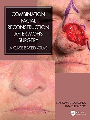 Local Flaps in Facial Reconstruction: 9780323683906: Medicine