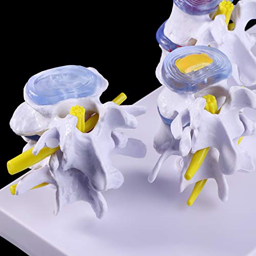 Abicial 1 Set Human Lumbar Lesion Spine Statue Display Model Medical Teaching Learning Tool