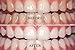 VS1 Teeth Whitening Pen, Whitening Treatments, No Sensitivity. MADE IN USA! 35% Carbamide Peroxide