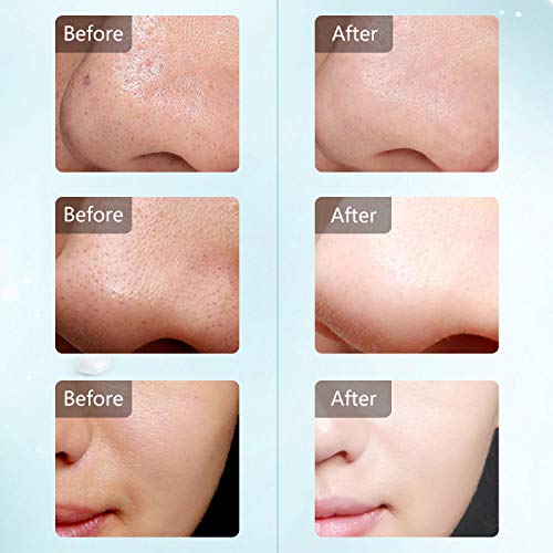 Facial Skin Scrubber Blackhead Remover Ultrasonic Face Spatula Comedone Extractor Pore Cleansing Facial Lifting Tool for Face Care - Thumbnail 3