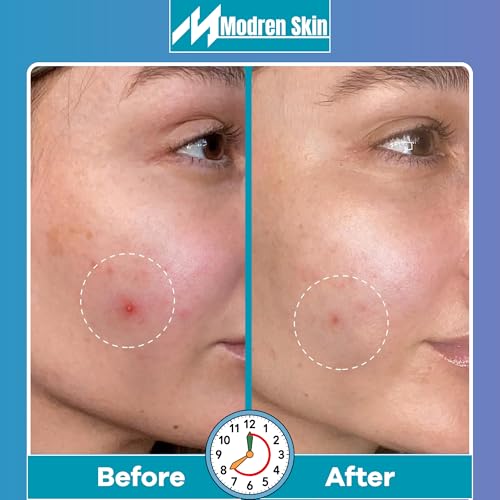 MODREN SKIN – 144 Pcs Pimple patches 4 Sheets – Hydrocolloid pimple patch with easy peel off cut lines in a resealable zipper bag – Acne Patch dots (Small 8mm, Medium 10mm)