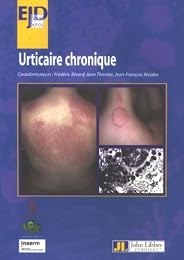 Urticaire chronique