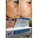 Best Cream Anti Melasma Reduces Dark & Brown Spots, Age Spots, Sun Spots, Pigmentation, Freckles 15 G. X 3 Tubes
