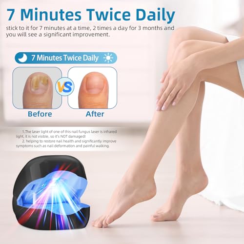 Nail Fungus Laser Device Upgrade, Anti-Fungal for Damaged and Discoloured